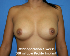 plastic-surgery-breast-augmentation